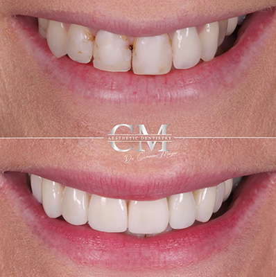 Porcelain Veneers