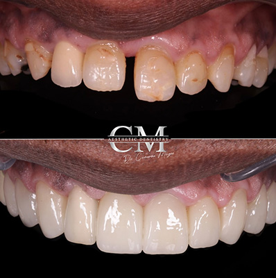 Porcelain Veneers