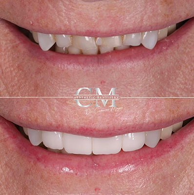 Porcelain Veneers